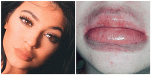 Taken from http://www.dailymail.co.uk/femail/article-3047484/Disturbing-new-Kylie-Jenner-challenge-sees-teens-suck-shot-glasses-blow-lips-double-size-disastrous-results.html
